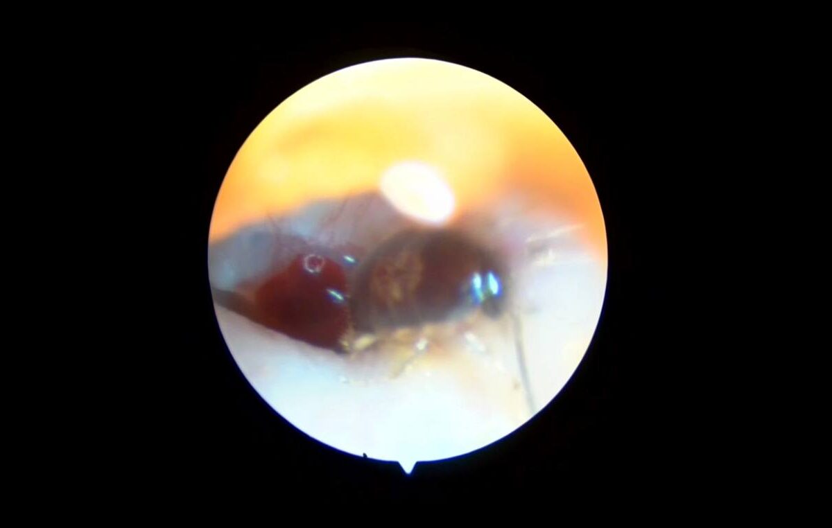 Рівненський лор Данильчук дістав таргана з вуха пацієнта (+ВІДЕО)