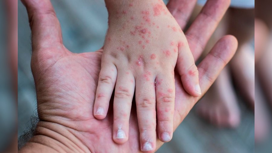 1 В Рівному очікують вакцину від найпоширенішого штаму менінгококу