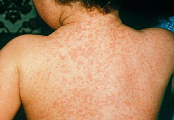 1 В Рівному очікують вакцину від найпоширенішого штаму менінгококу