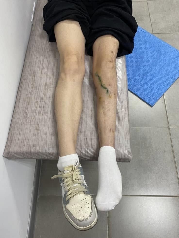 1 Лікарі Рівненщини поставили на ноги 18-річну дівчину, яка два роки самостійно не ходила