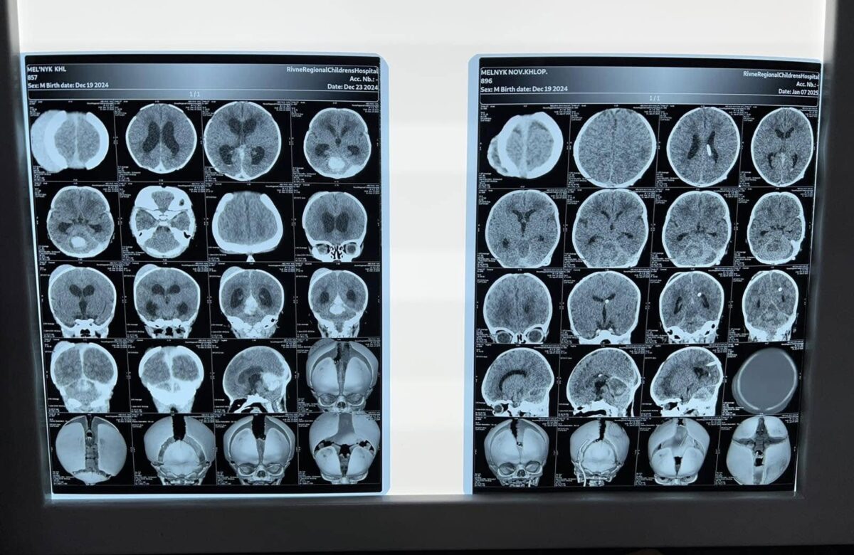 Прооперували на 6й день життя: як рівненські лікарі рятували малюка