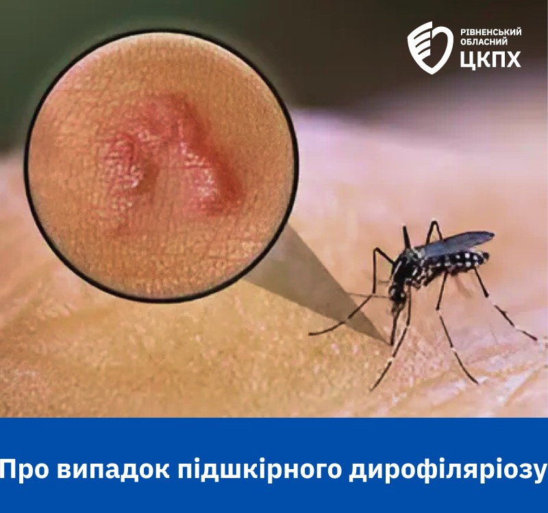 На Рівненщині вперше у 2025 році виявили паразита під шкірою 0000