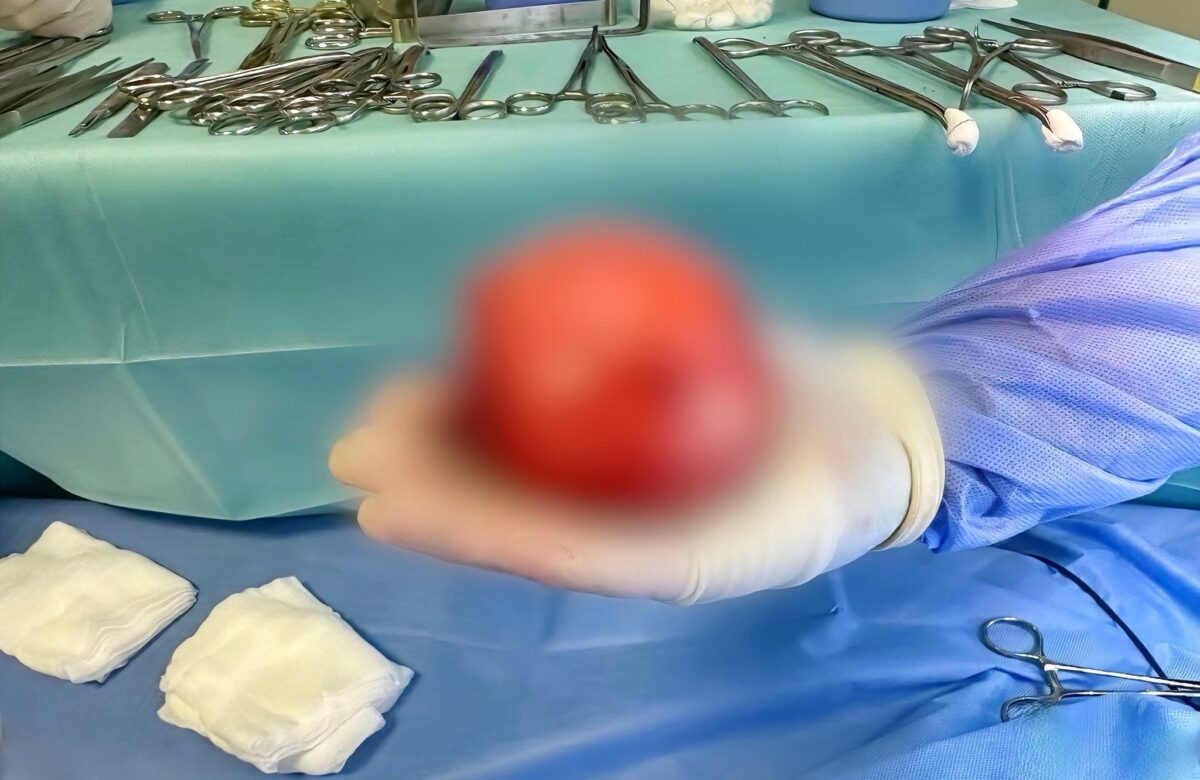 Лікарі видалили у маленької рівнянки пухлину розміром з долоню