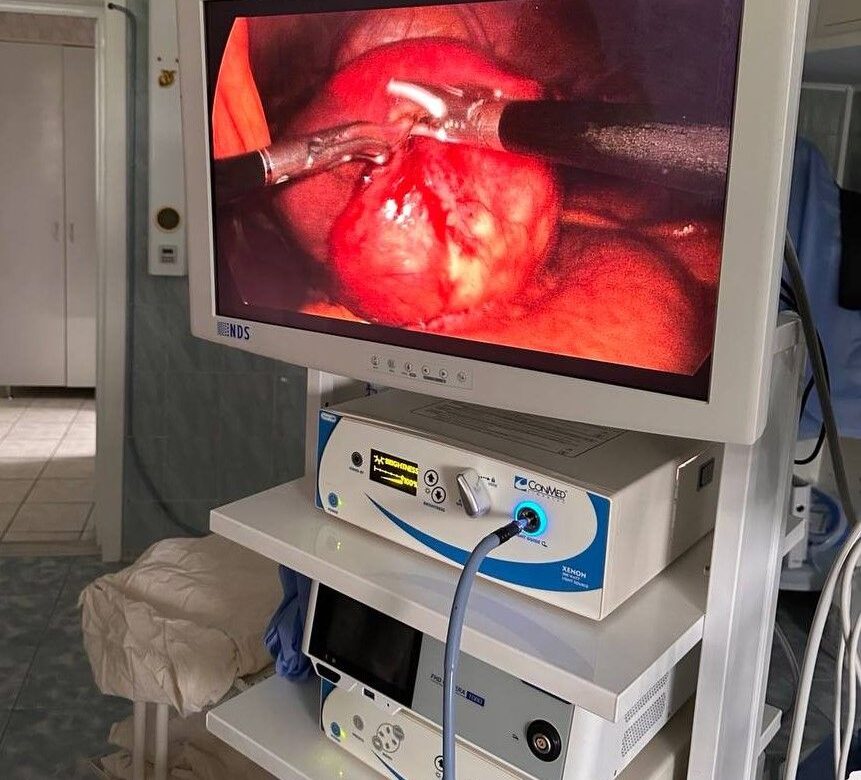 Рівненські хірурги провели високотехнологічну операцію: видалили паразитарні новоутворення