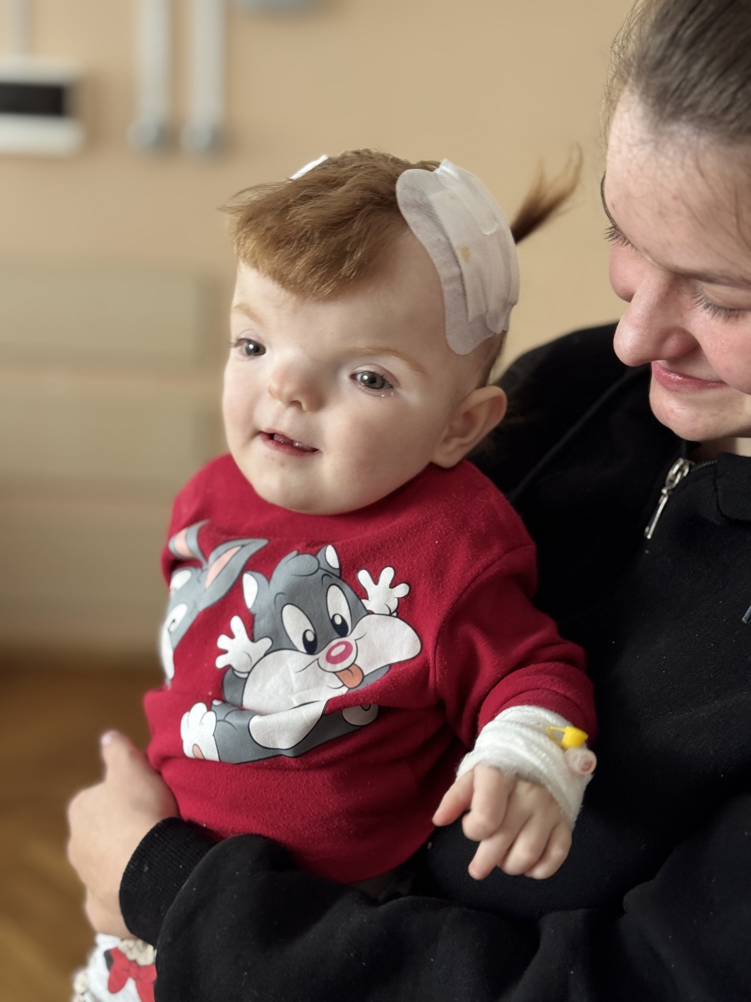1 Маленька Емілія з Рівненщини місяць носила металеві дистрактори у черепі