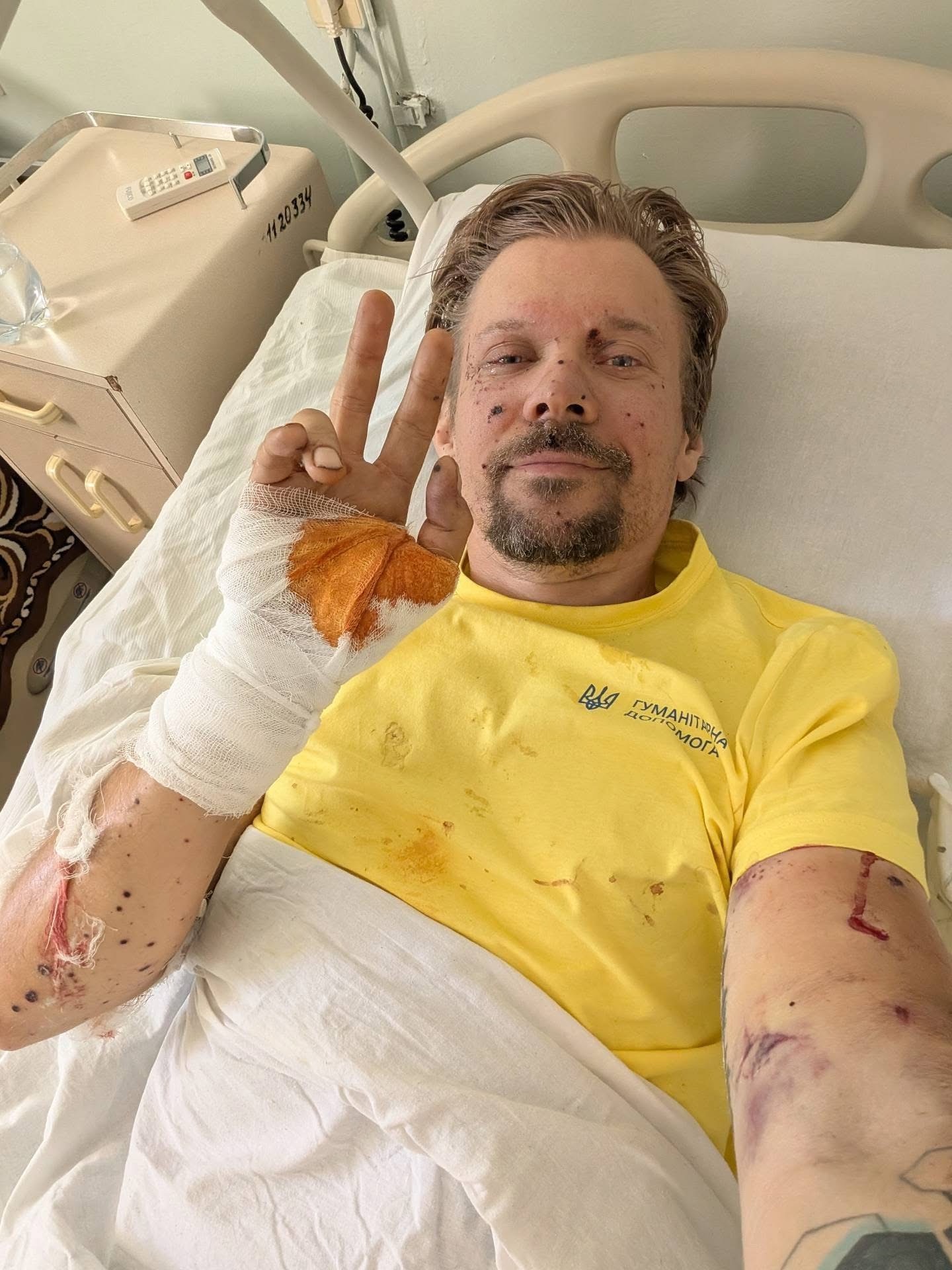 «Ходити доведеться не скоро»: поранений депутат із Рівного розповів про свій стан 0000
